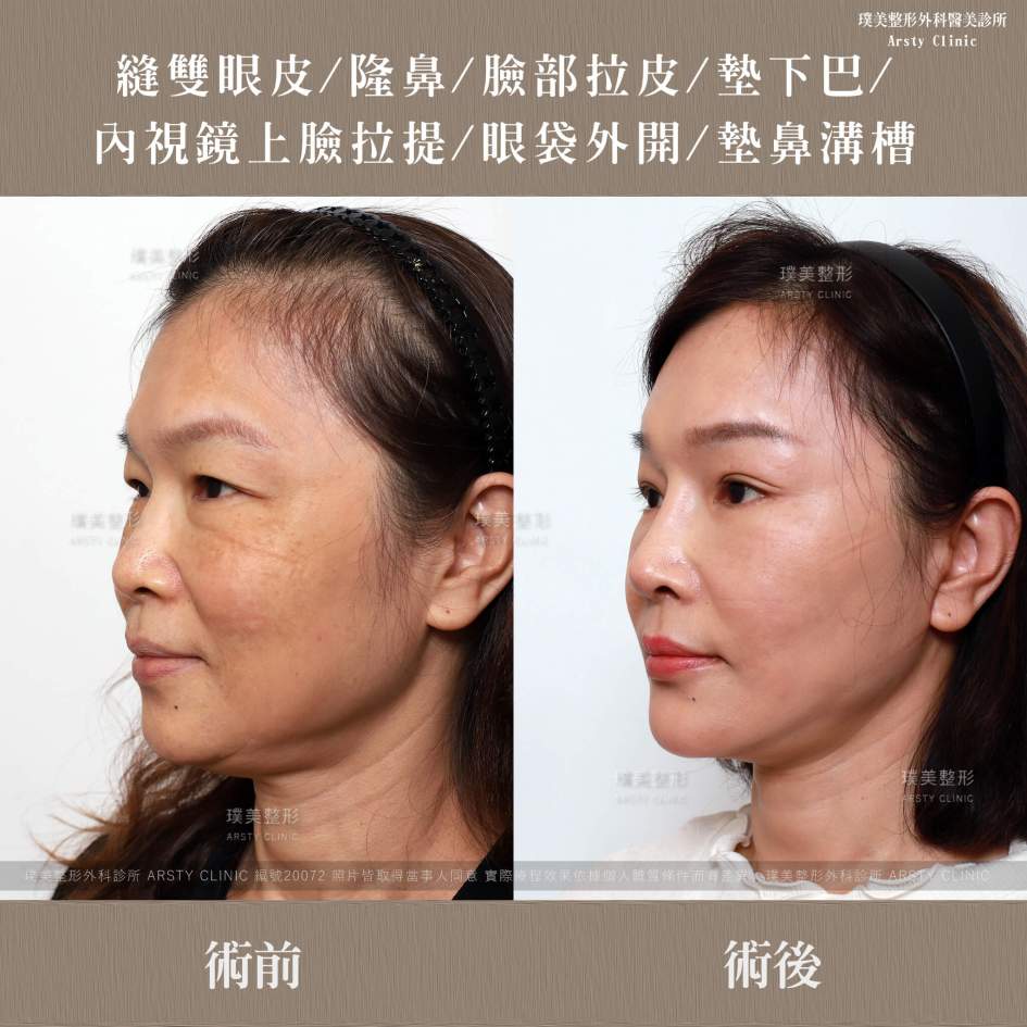 隆鼻手術案例推薦