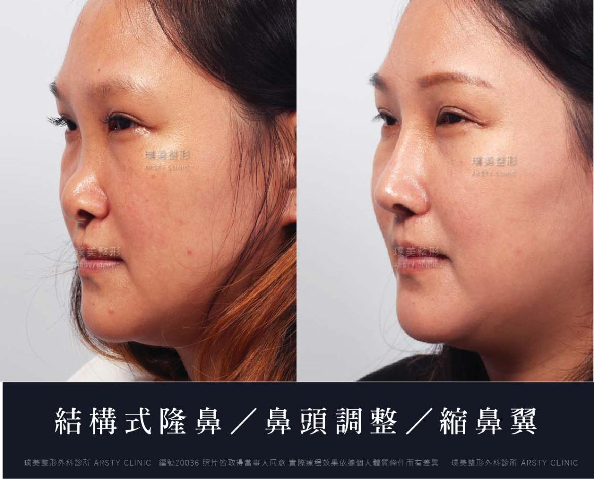 隆鼻手術案例推薦