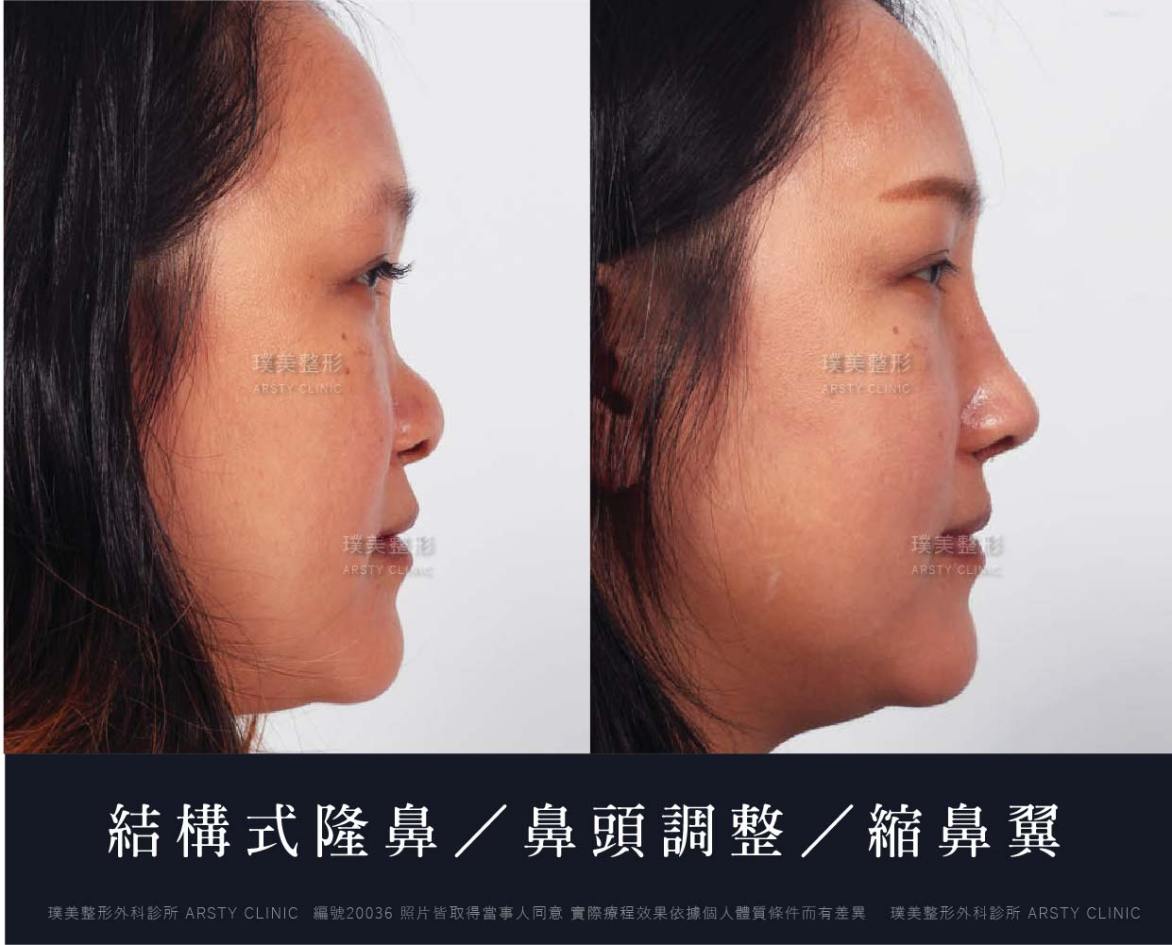 隆鼻手術案例推薦