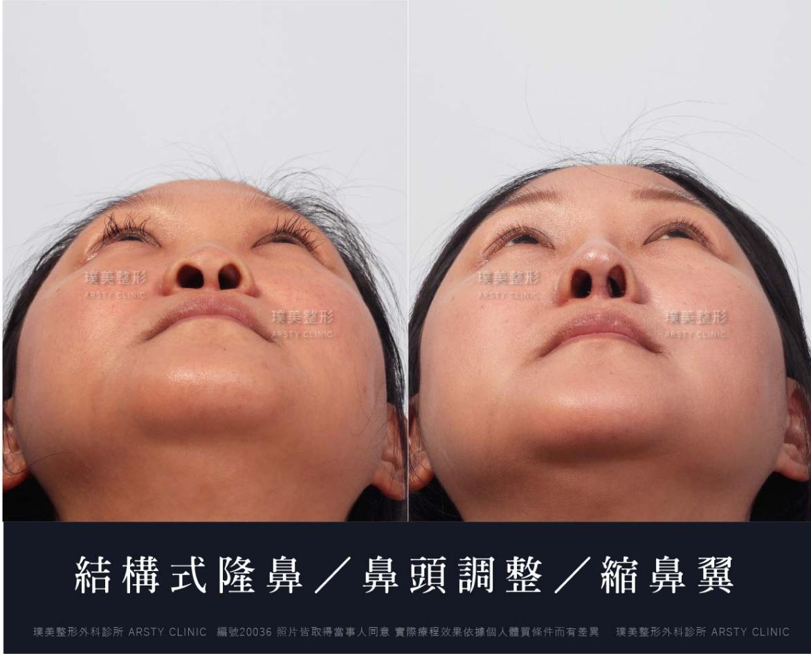 隆鼻手術案例推薦