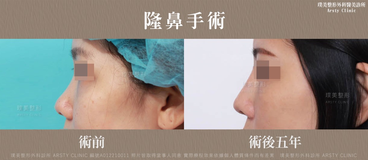 隆鼻手術案例推薦
