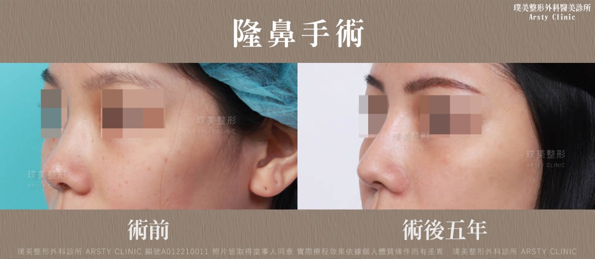 隆鼻手術案例推薦