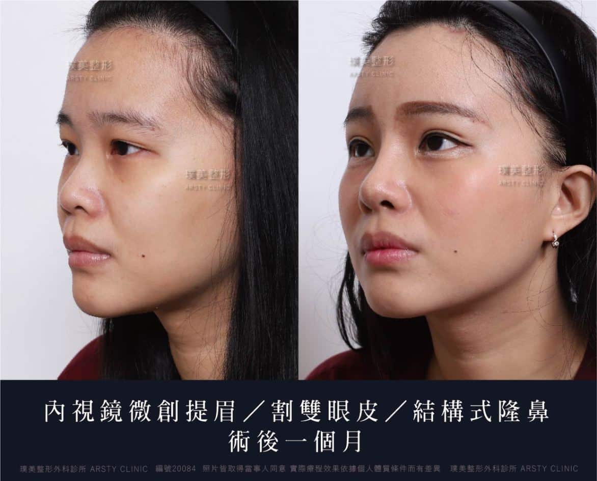 隆鼻手術案例推薦