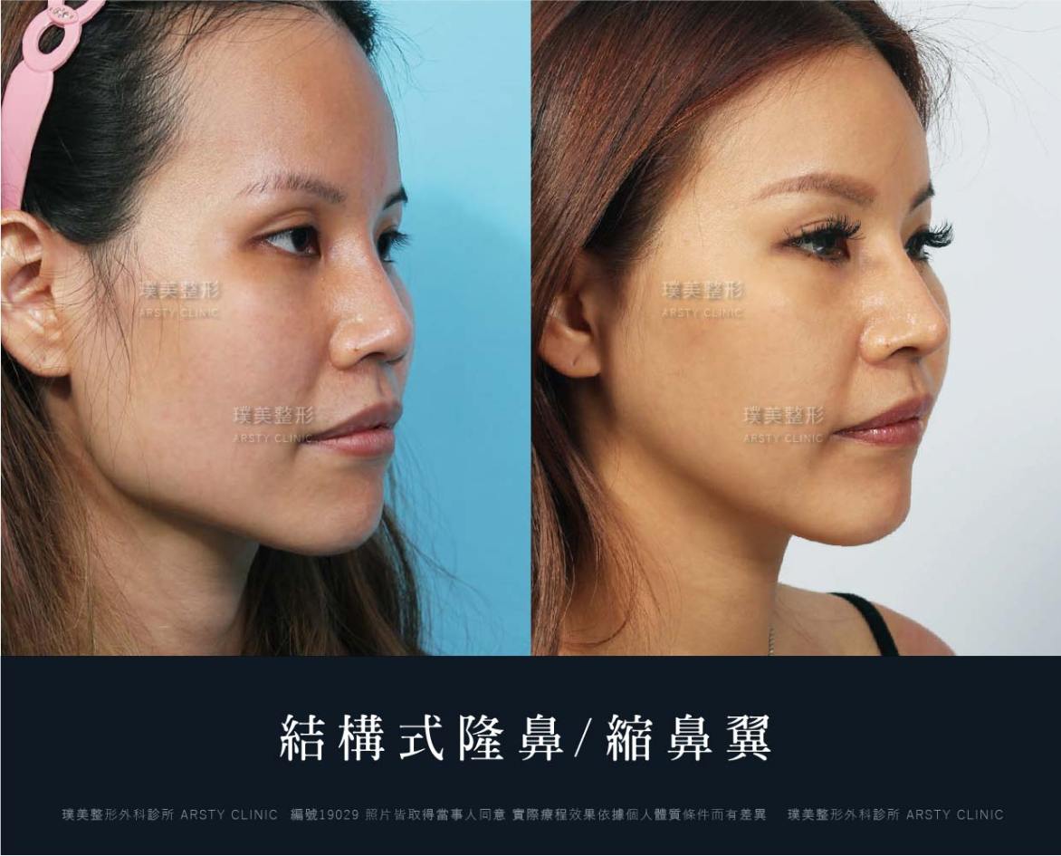 隆鼻手術案例推薦
