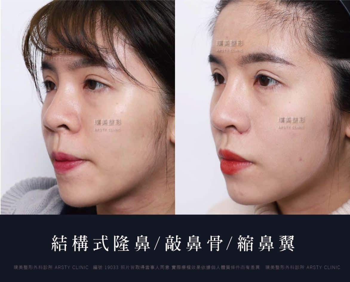 隆鼻手術案例推薦