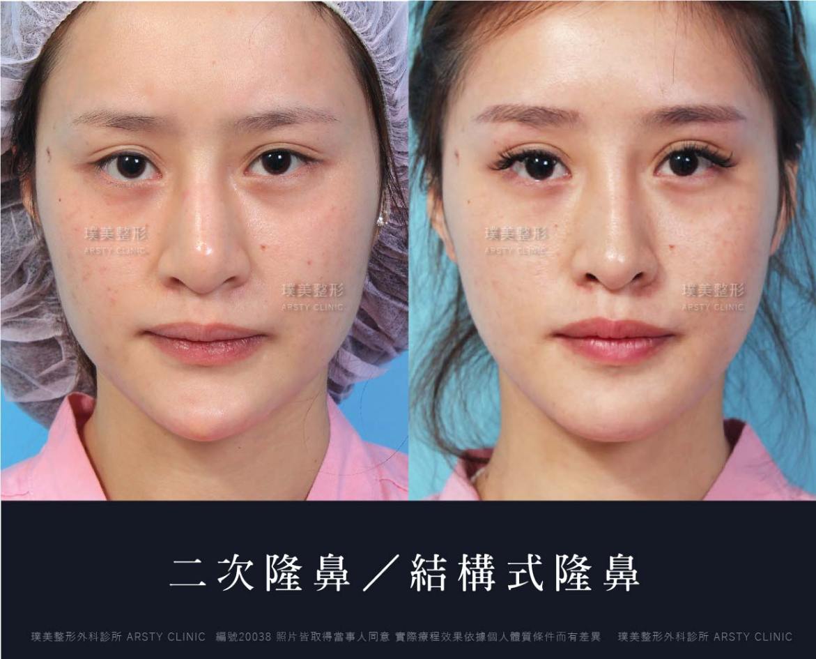 隆鼻手術案例推薦