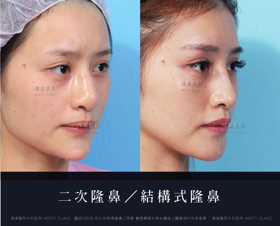隆鼻手術案例推薦