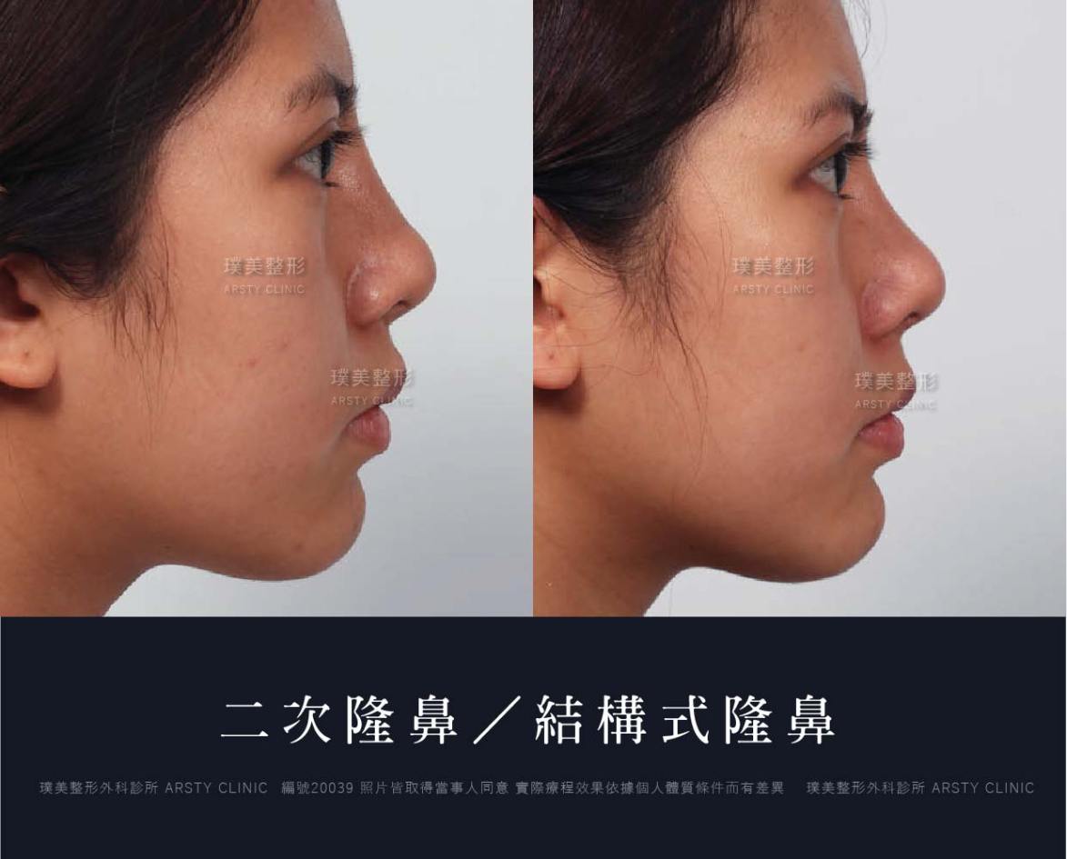 隆鼻手術案例推薦