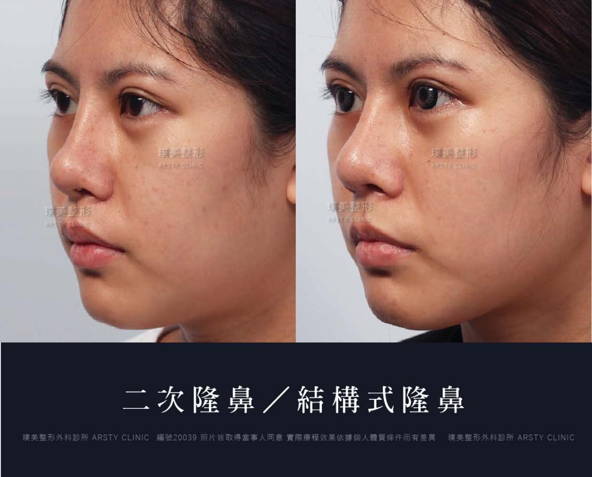 隆鼻手術案例推薦