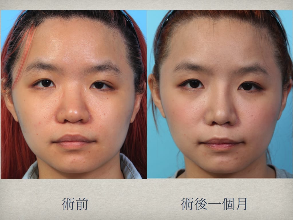 隆鼻手術案例推薦