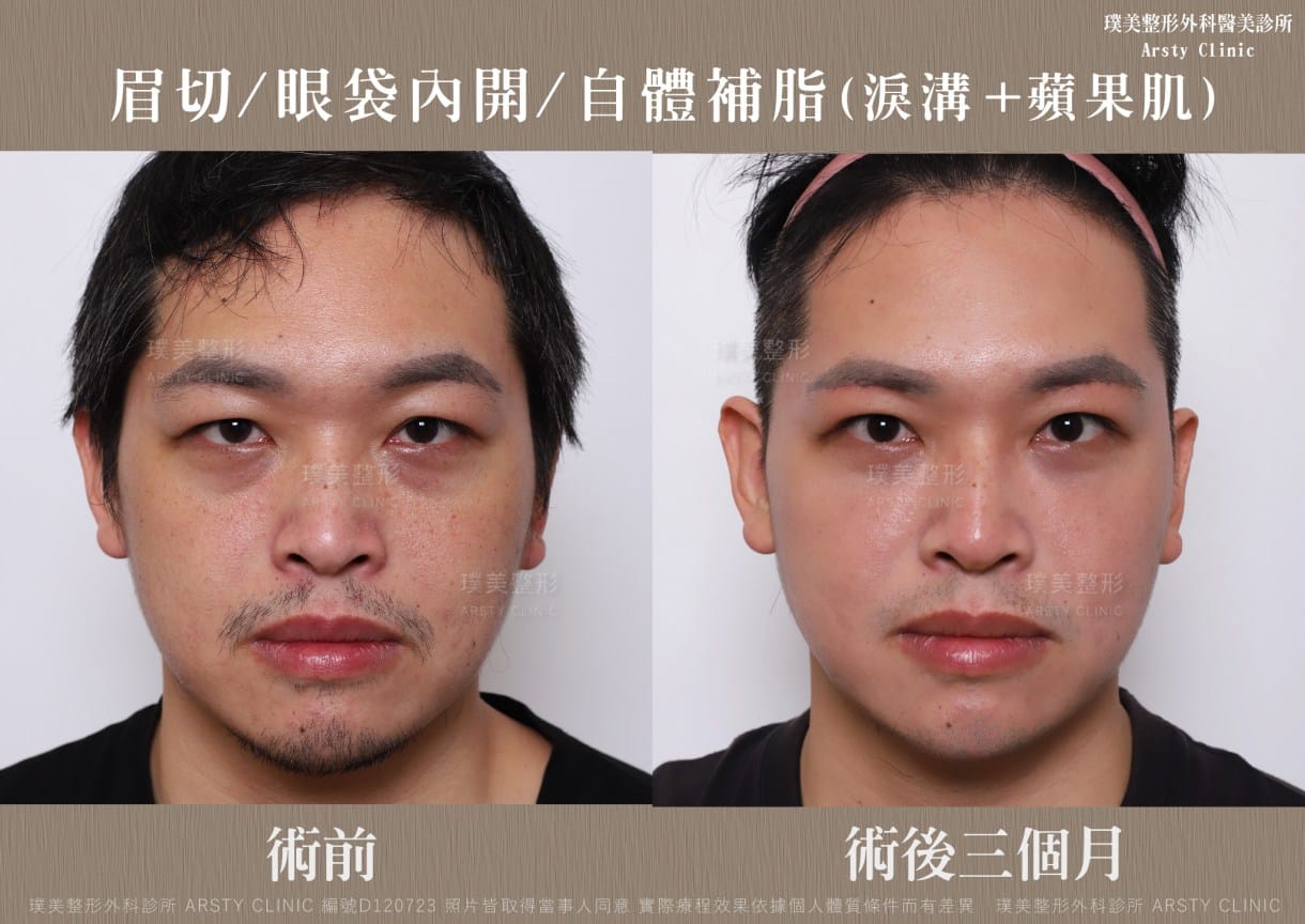 本院複合式眼袋手術優勢