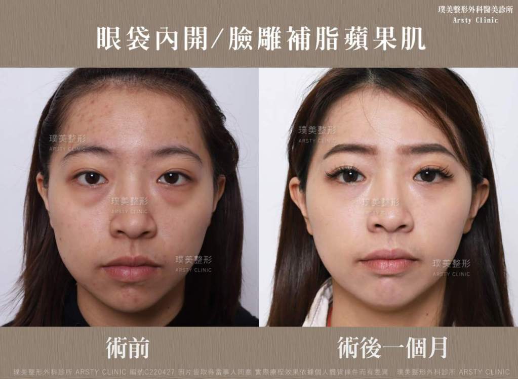 隱痕眼袋手術-14