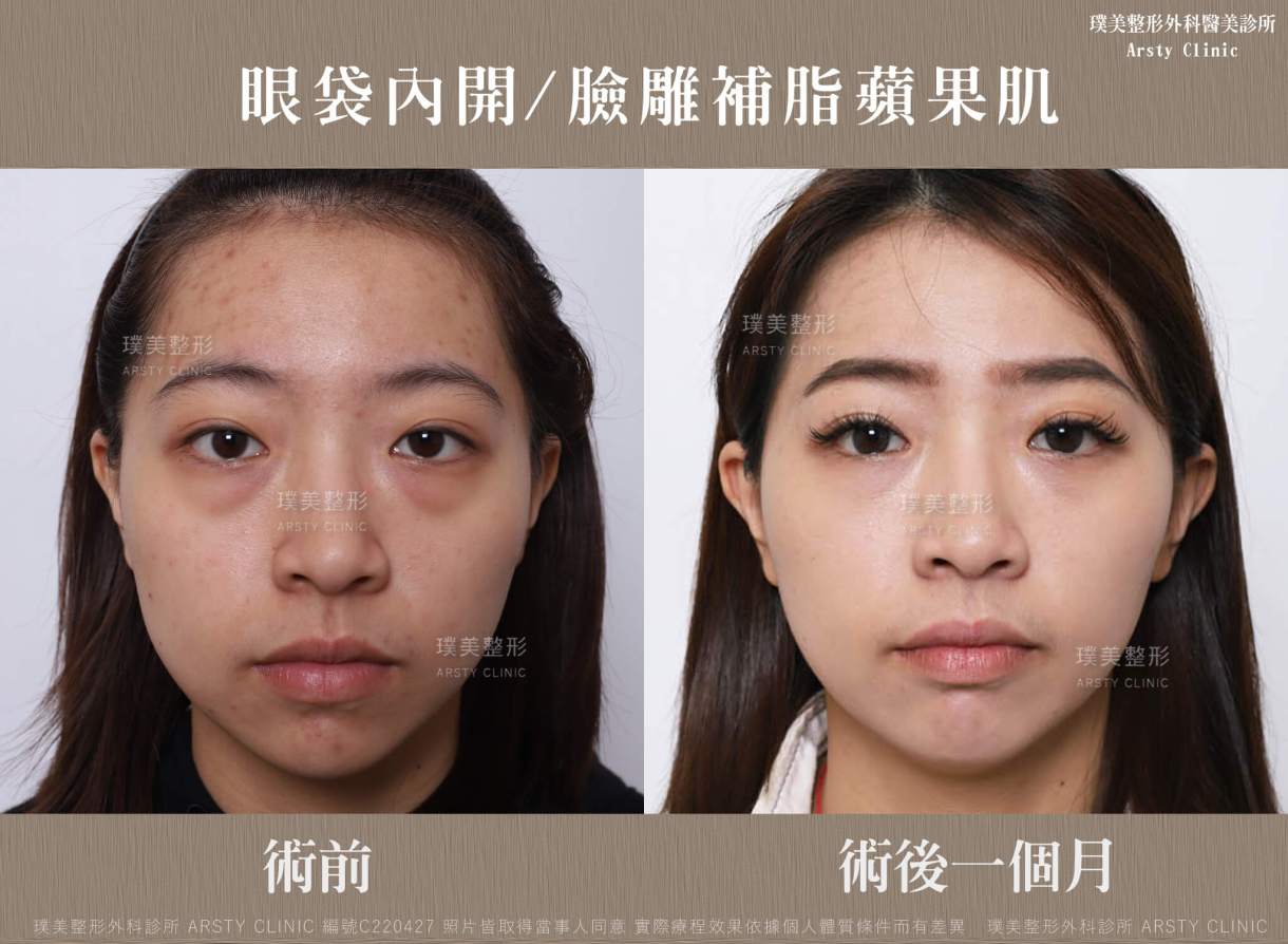 本院複合式眼袋手術優勢