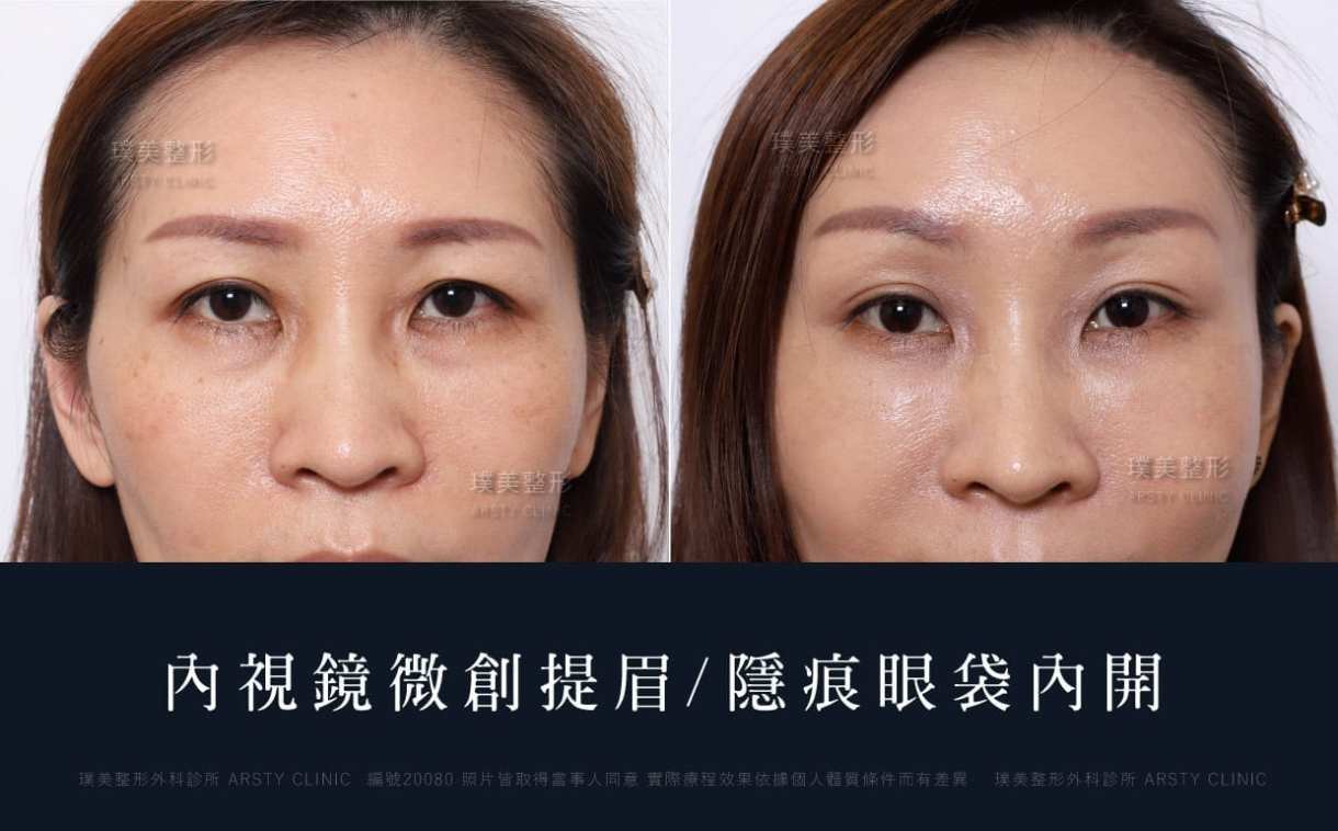 本院複合式眼袋手術優勢