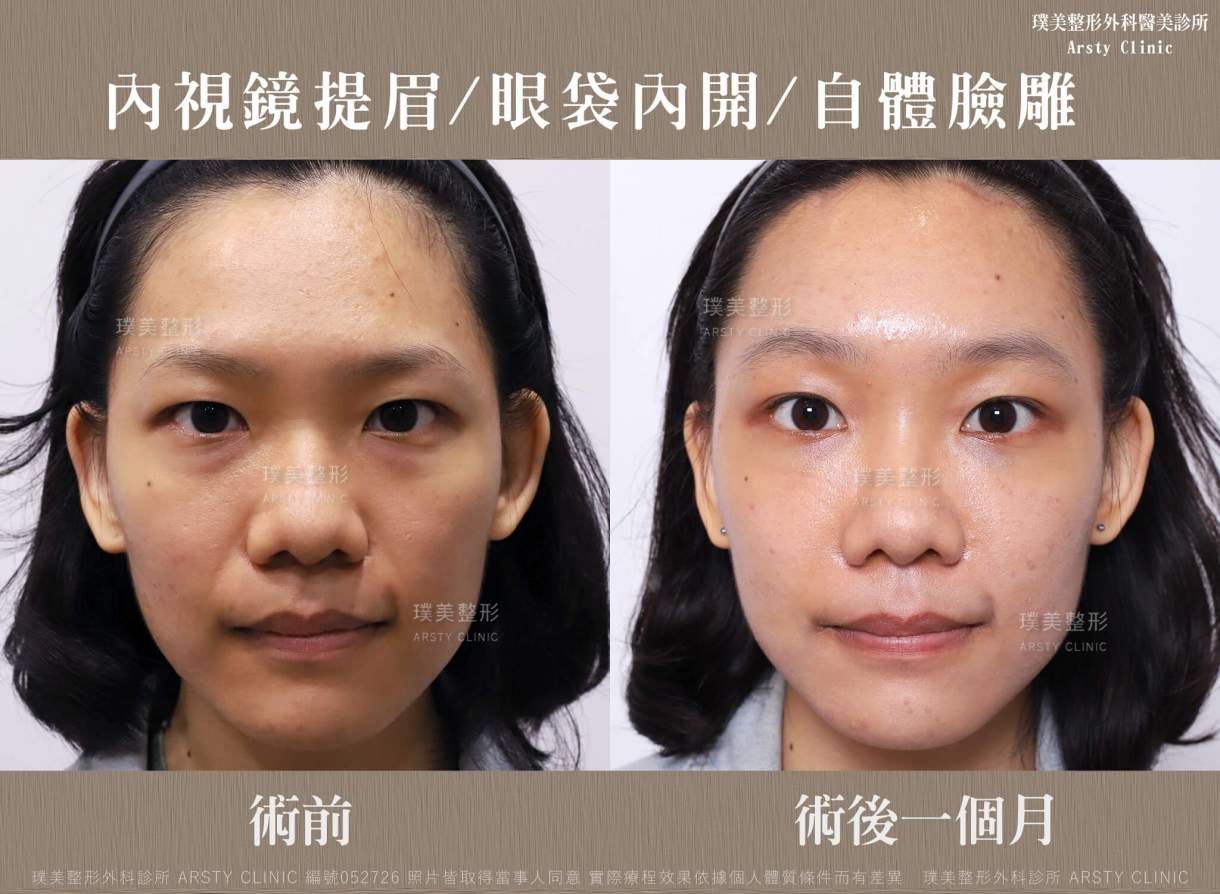 本院複合式眼袋手術優勢