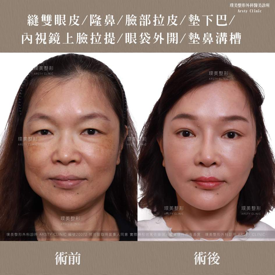 本院複合式眼袋手術優勢