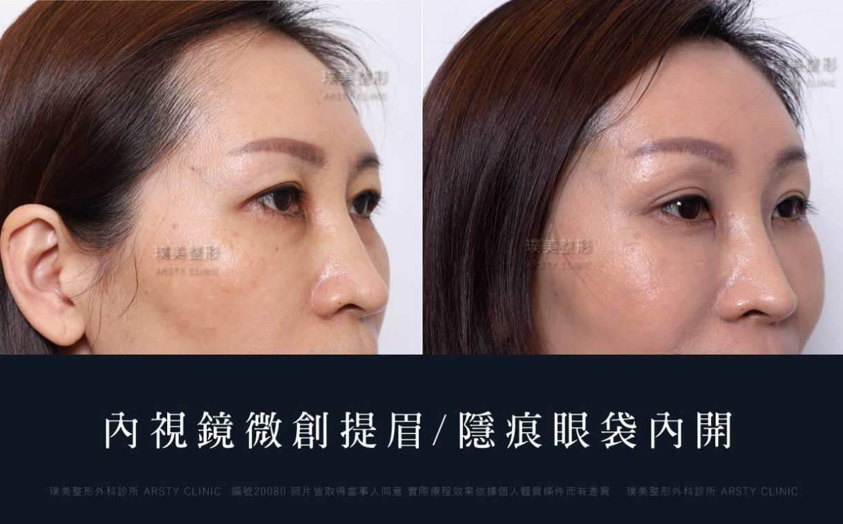 本院複合式眼袋手術優勢