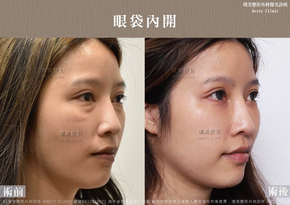 本院複合式眼袋手術優勢