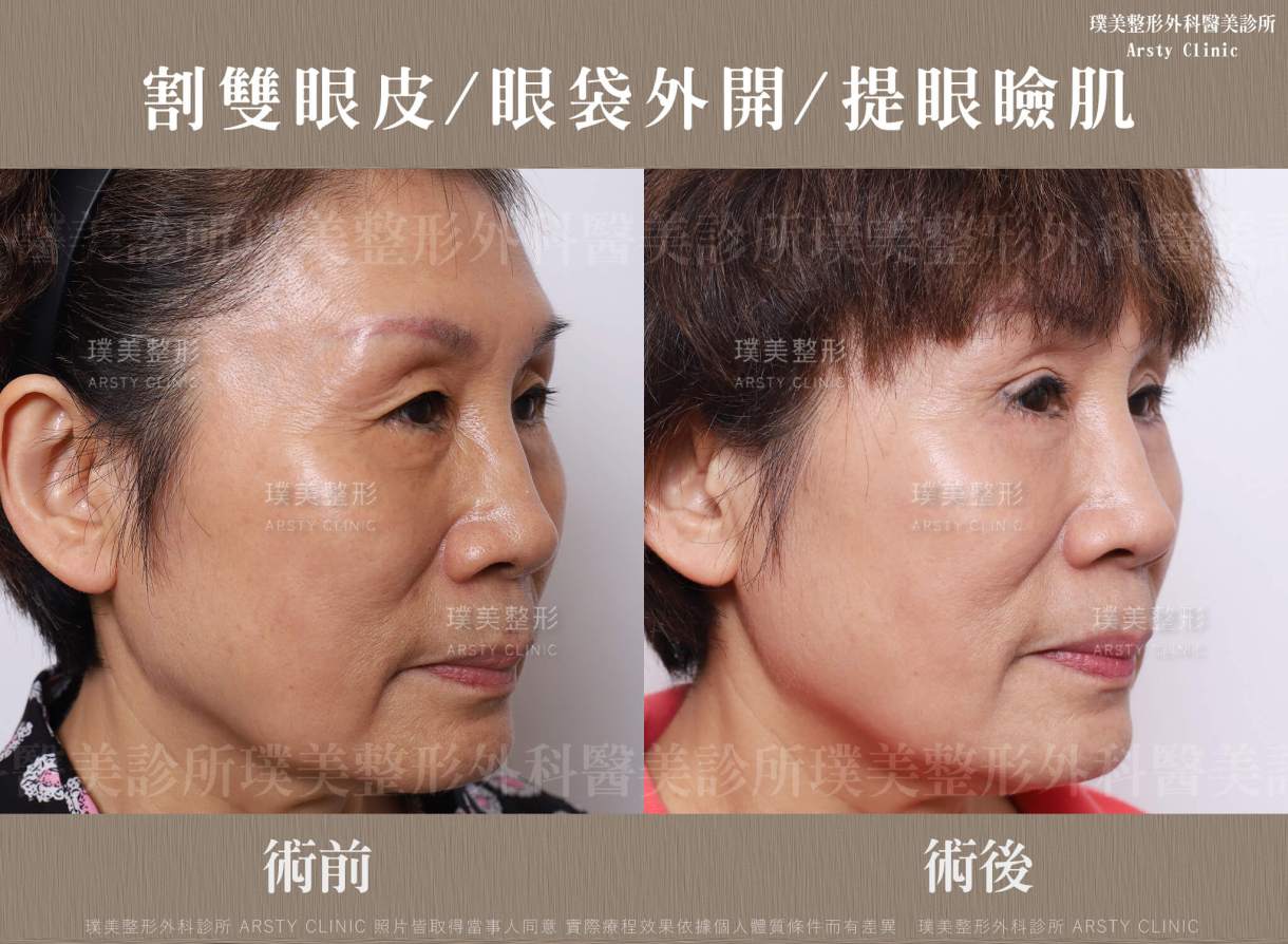 本院複合式眼袋手術優勢