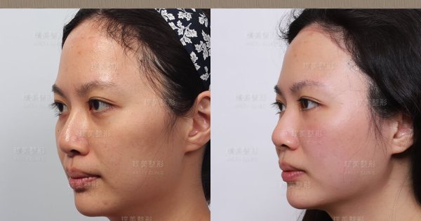 本院複合式眼袋手術優勢