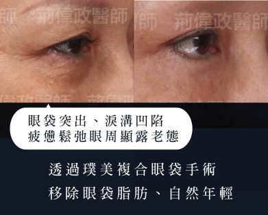 本院複合式眼袋手術優勢
