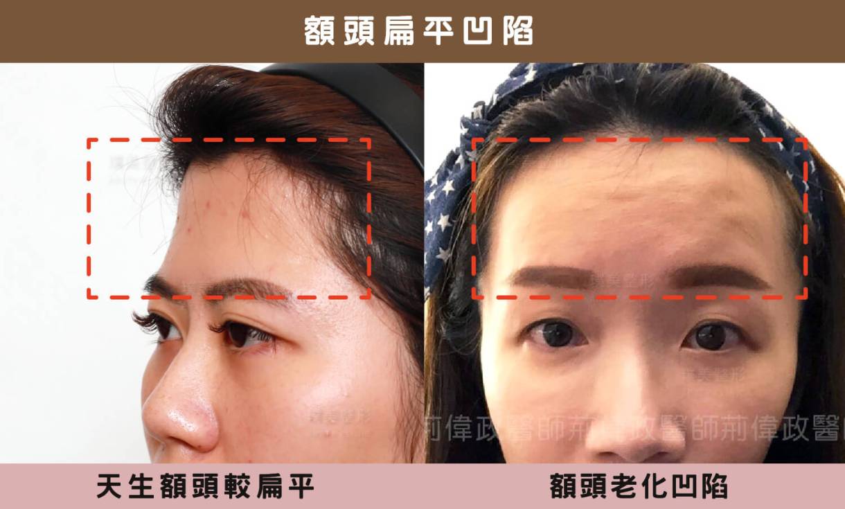 ハリがあり、ふっくらとしていて、バランスが良い――完璧な額に欠かせない3つの要素