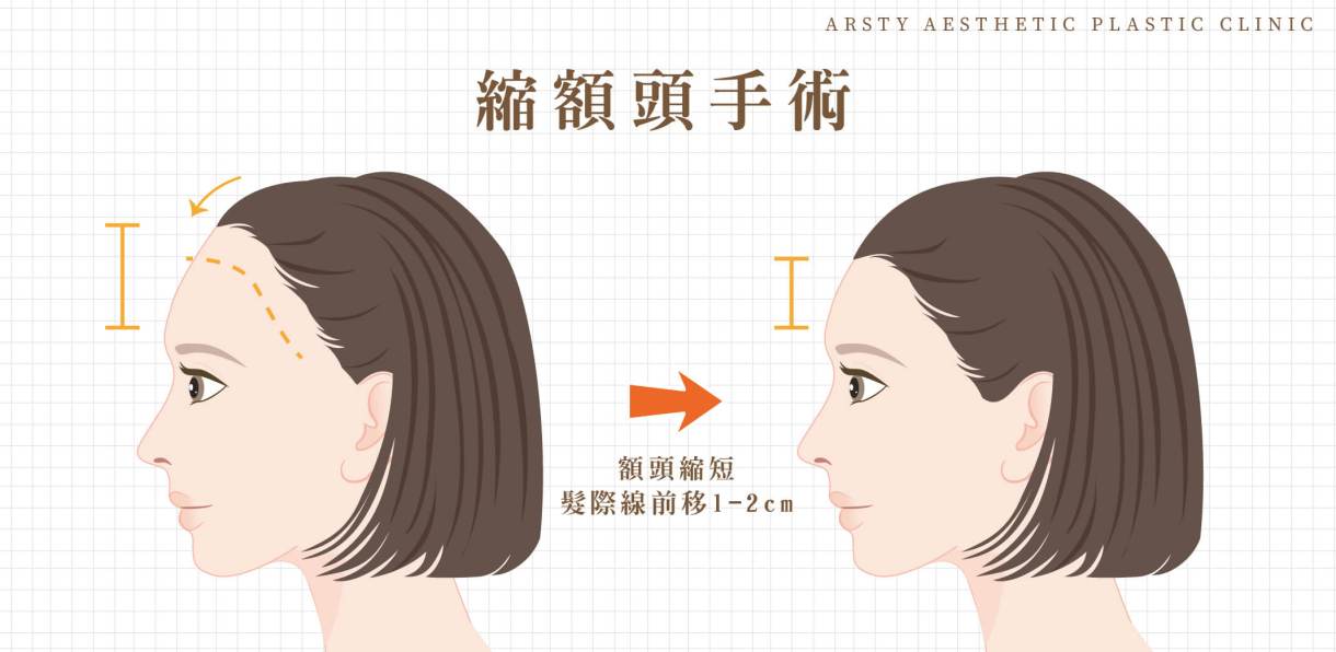 額の若返り