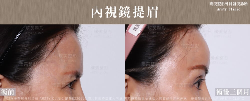 額の若返り治療症例共有