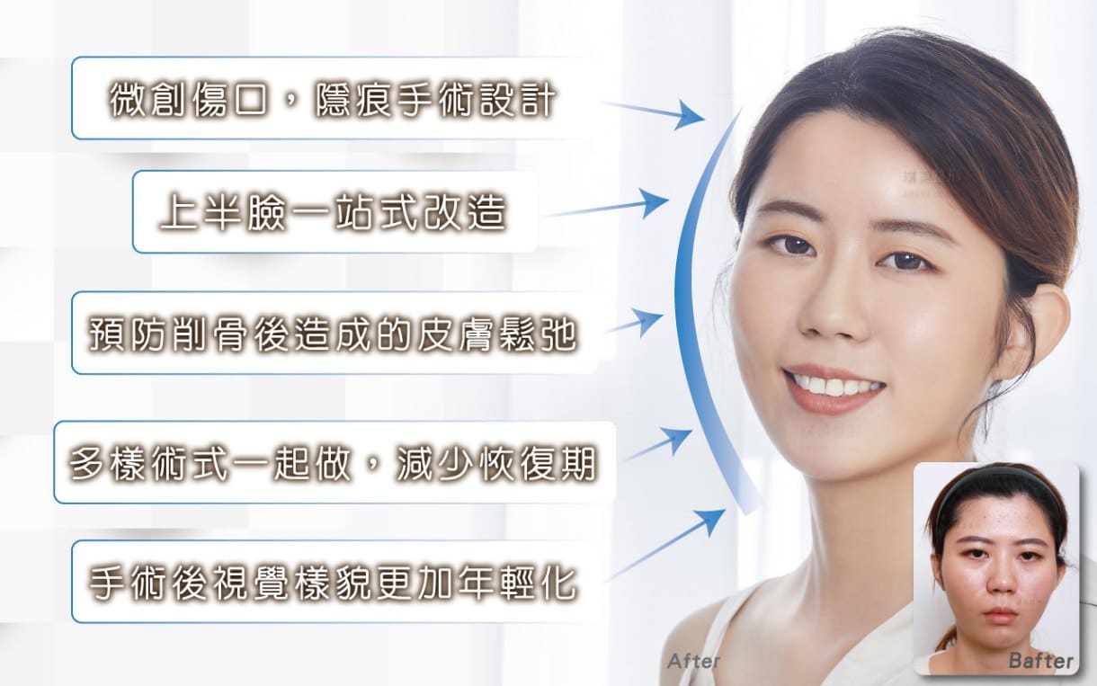 頬骨縮小術＋内視鏡的眉リフト治療の利点