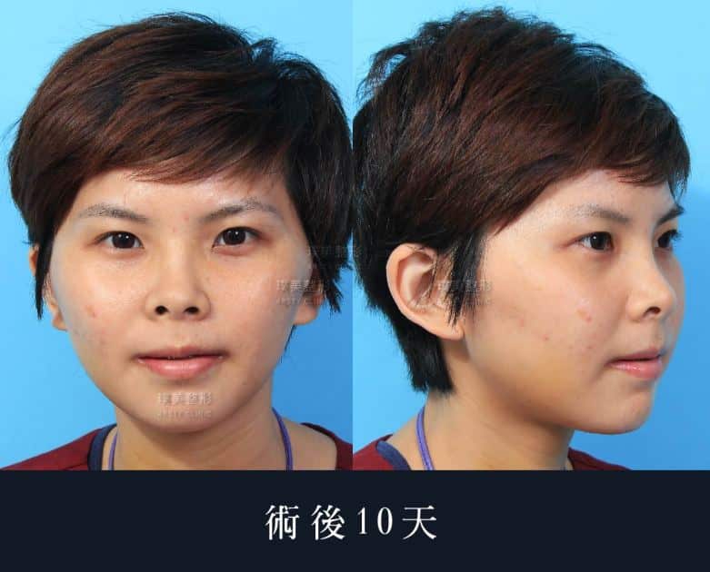 Pumei低侵襲頬骨縮小術