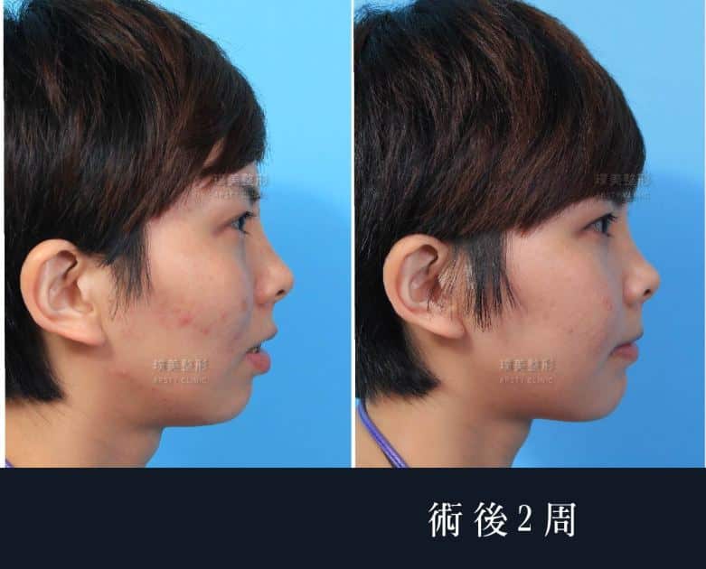Pumei低侵襲頬骨縮小術