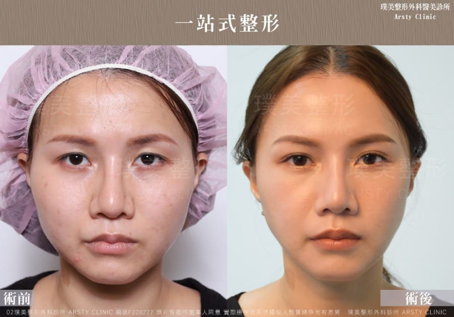 術後体験談