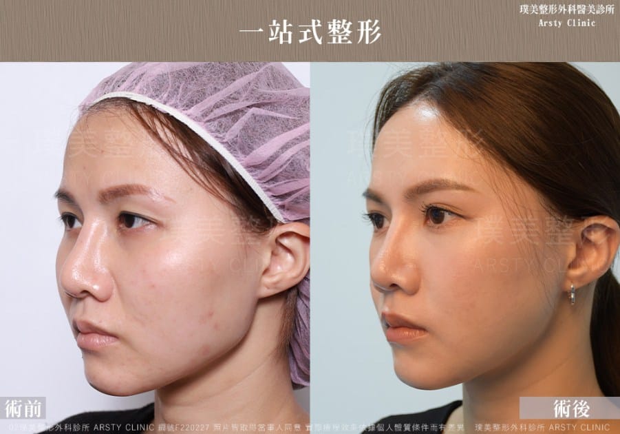 術後体験談