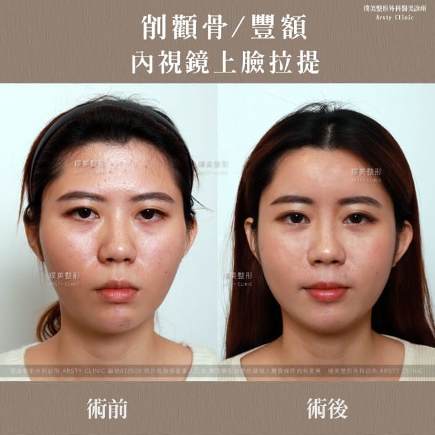 術後体験談