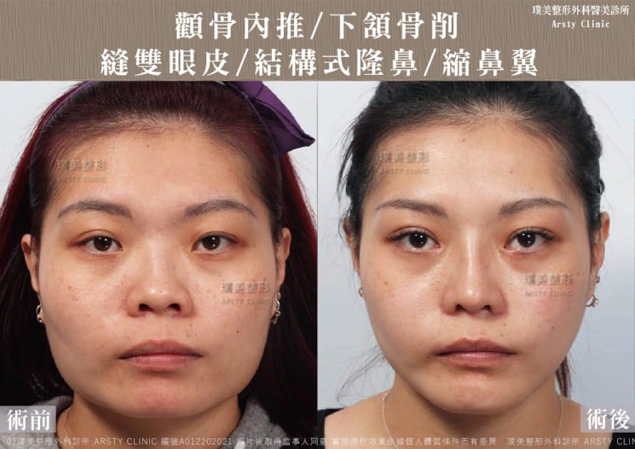 術後体験談