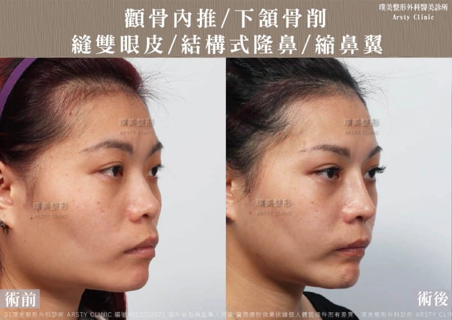 術後体験談