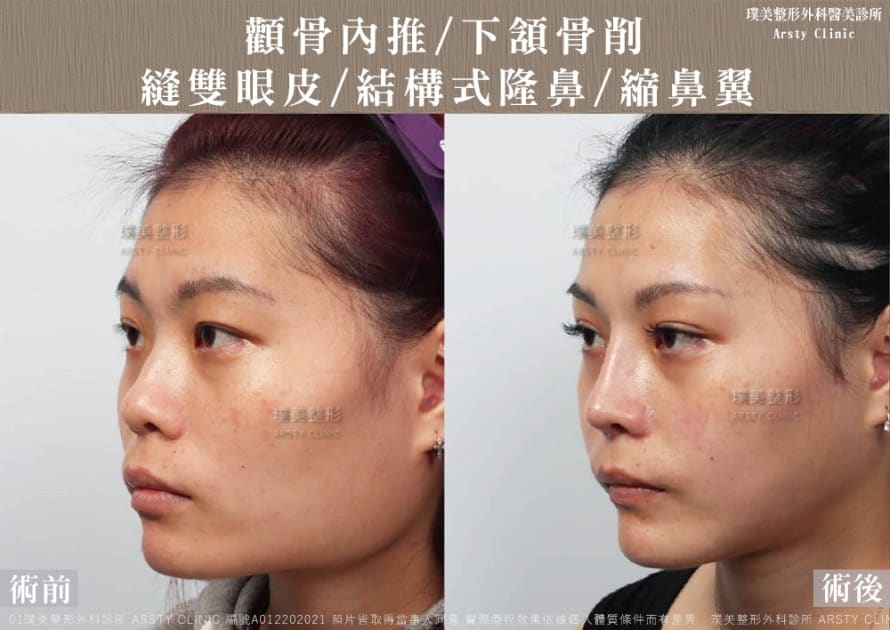 術後体験談