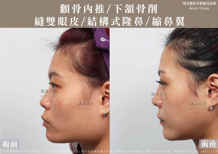 術後体験談