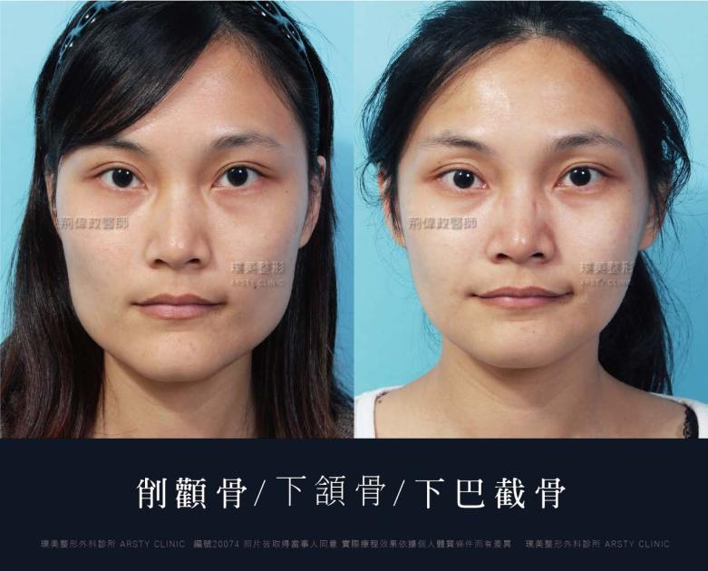 術後体験談