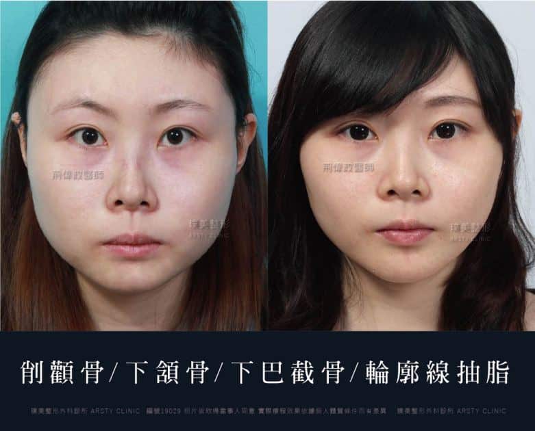 術後体験談