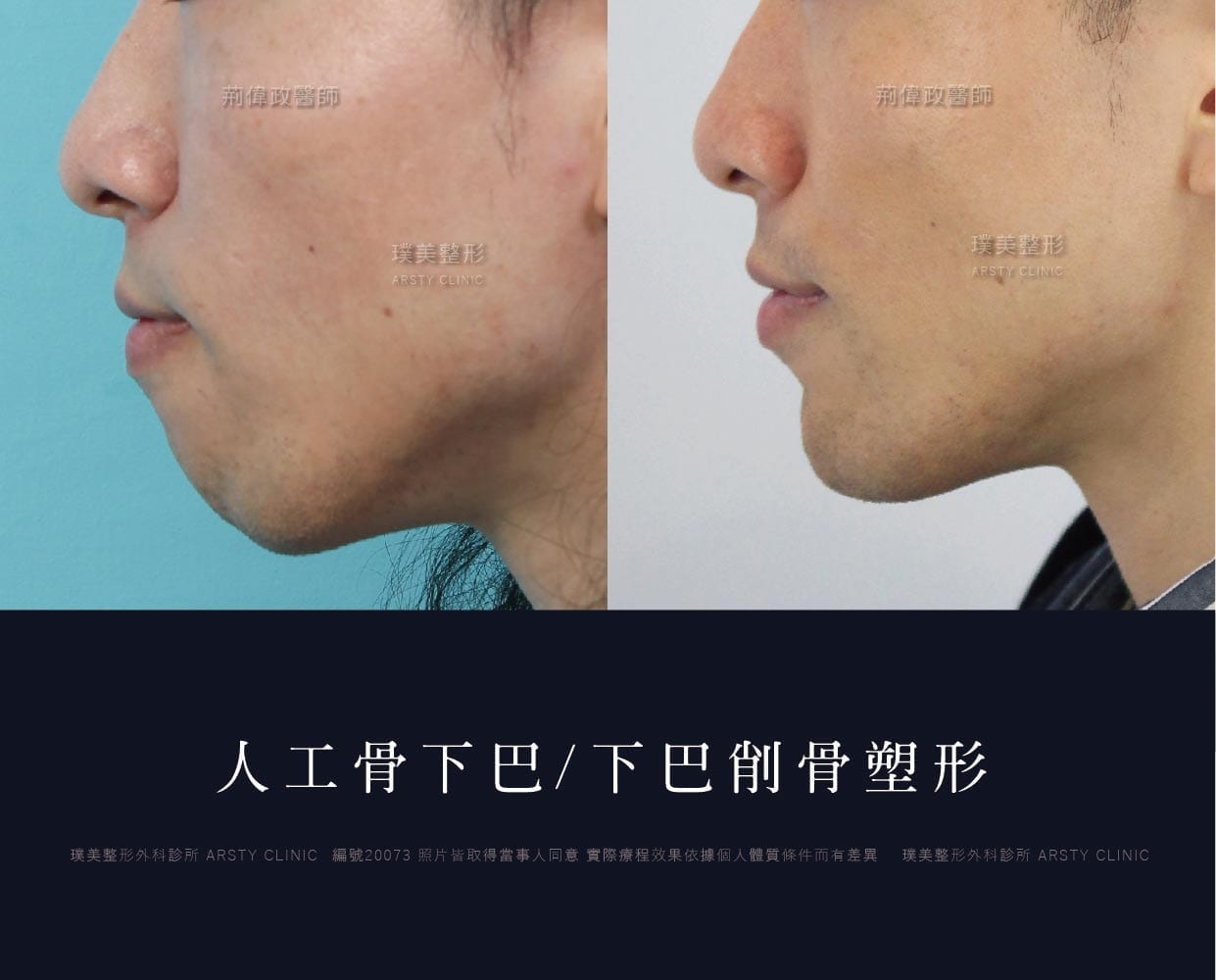 人工骨下巴.下巴手術.台北推薦下巴dcard推薦.墊下巴手術
