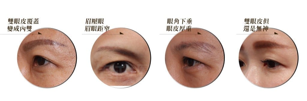 ジン・ウェイジェン医師が推奨する内視鏡を用いた低侵襲眉リフト手術。眉リフト手術は、眼窩周囲のたるみを改善する効果があります。