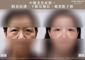 中臉老化症狀︰眼袋淚溝、下眼皮變長、蘋果肌下移_F220316_1_眼袋 打霧