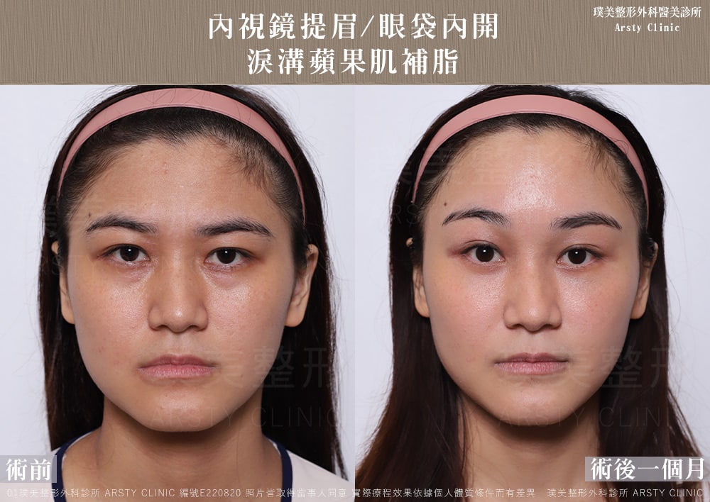 內視鏡提眉_眼袋內開_淚溝蘋果肌補脂_E220820-1M01BA