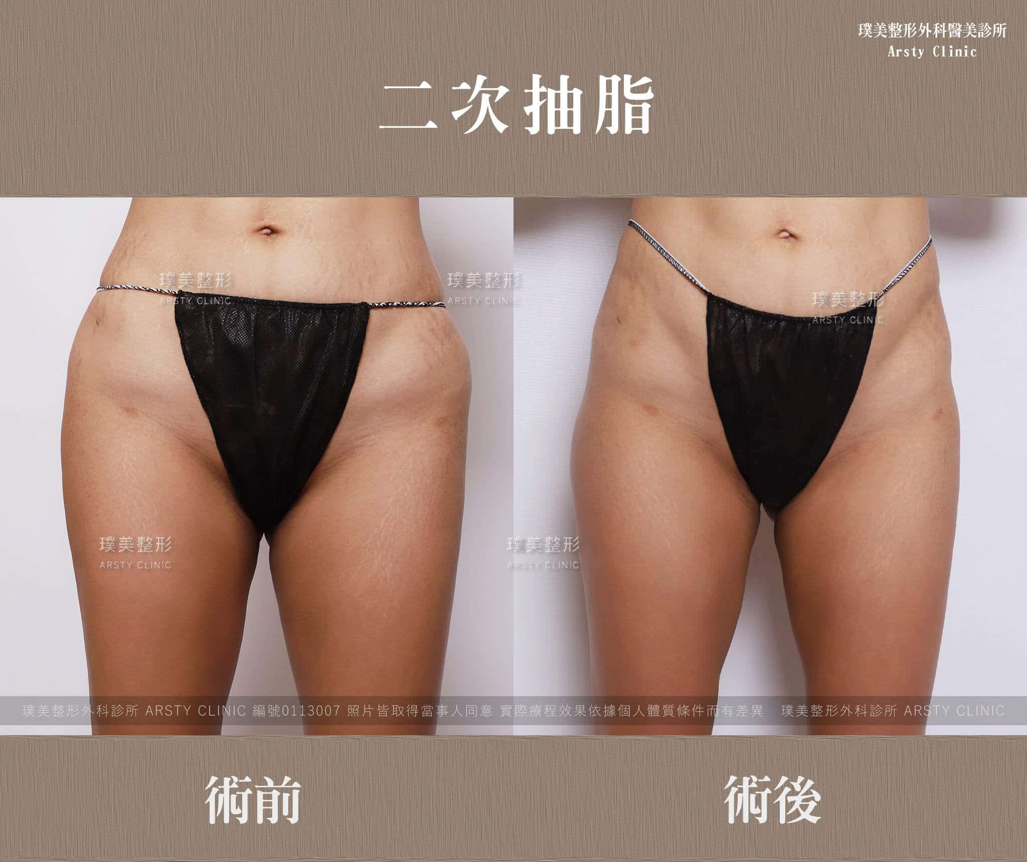 Second liposuction