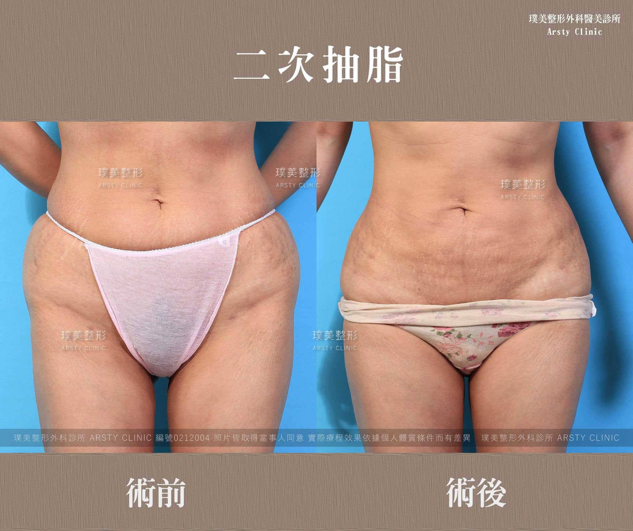 Second liposuction