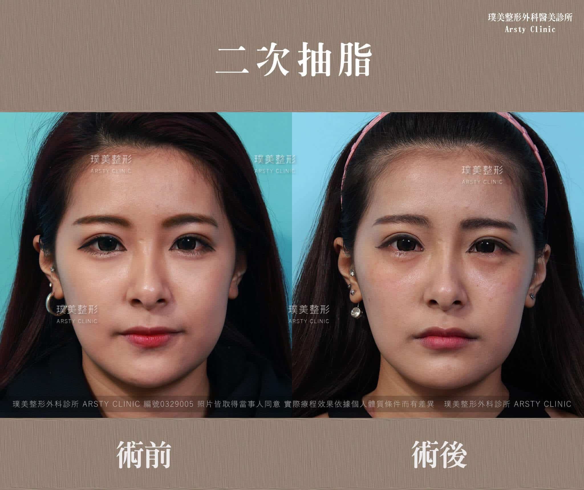 Second liposuction