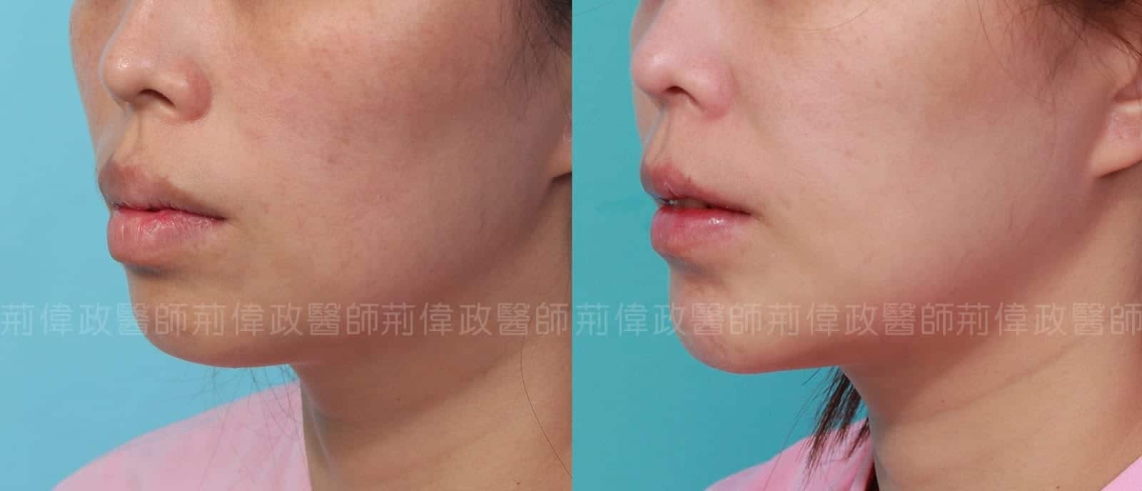 下巴整形、下巴整形推薦、墊下巴費用、台北墊下巴推薦、墊下巴材質.jpg 的副本