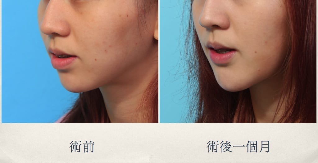 下巴整形、台北整型診所推薦、台北台中台南權威醫師推薦、墊下巴、墊下巴整形.jpg 的副本