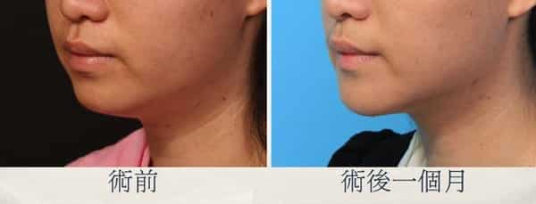 下巴整形、墊下巴分享、尖下巴整形、下巴整形推薦、墊下巴費用.jpg 的副本
